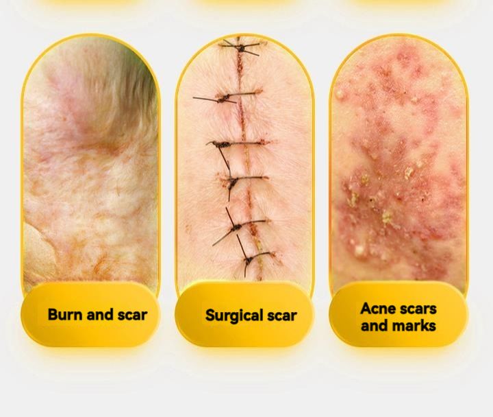 Medical Silicone Scar Gel Scar Cream Burn Burn C-section Scar Removal Cream