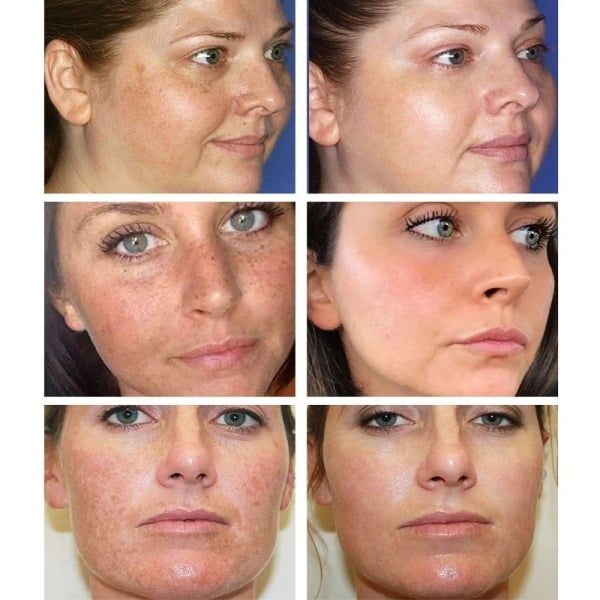 Whitening Freckle Cream Remove Melasma Cream Remove Dark Spots Melanin Melasma Remover Brighten Skin Anti-Aging Skin Lightening