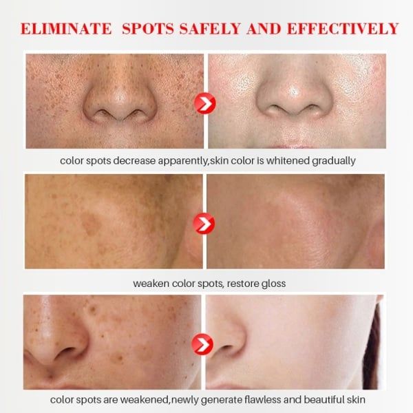 Whitening Freckle Cream Remove Melasma Cream Remove Dark Spots Melanin Melasma Remover Brighten Skin Anti-Aging Skin Lightening