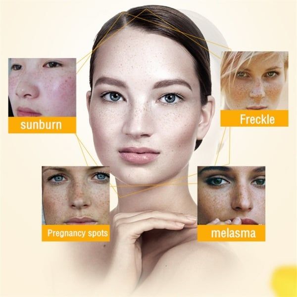 Whitening Freckle Cream Remove Melasma Cream Remove Dark Spots Melanin Melasma Remover Brighten Skin Anti-Aging Skin Lightening