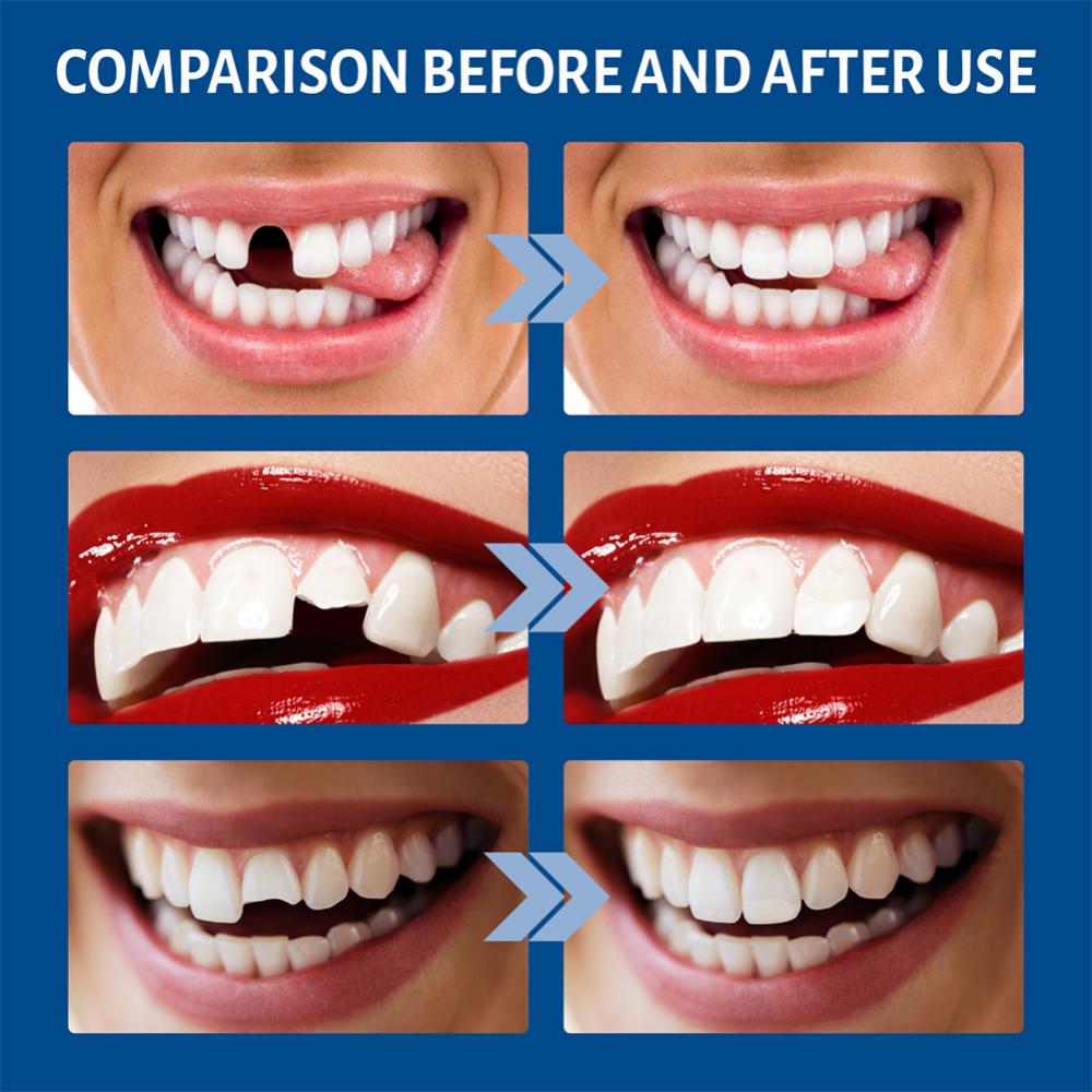 False Teeth Solid Glue Temporary Tooth Repair Kit Moldable Thermal Fitting Teeth Pellet Adhesive Tooth Care Tool