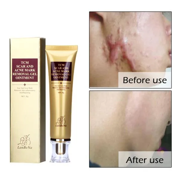 LANBENA Acne Scar Removal Cream Skin Repair Face Cream Acne Spots Acne Treatment Blackhead Whitening Cream Stretch Marks 30ml