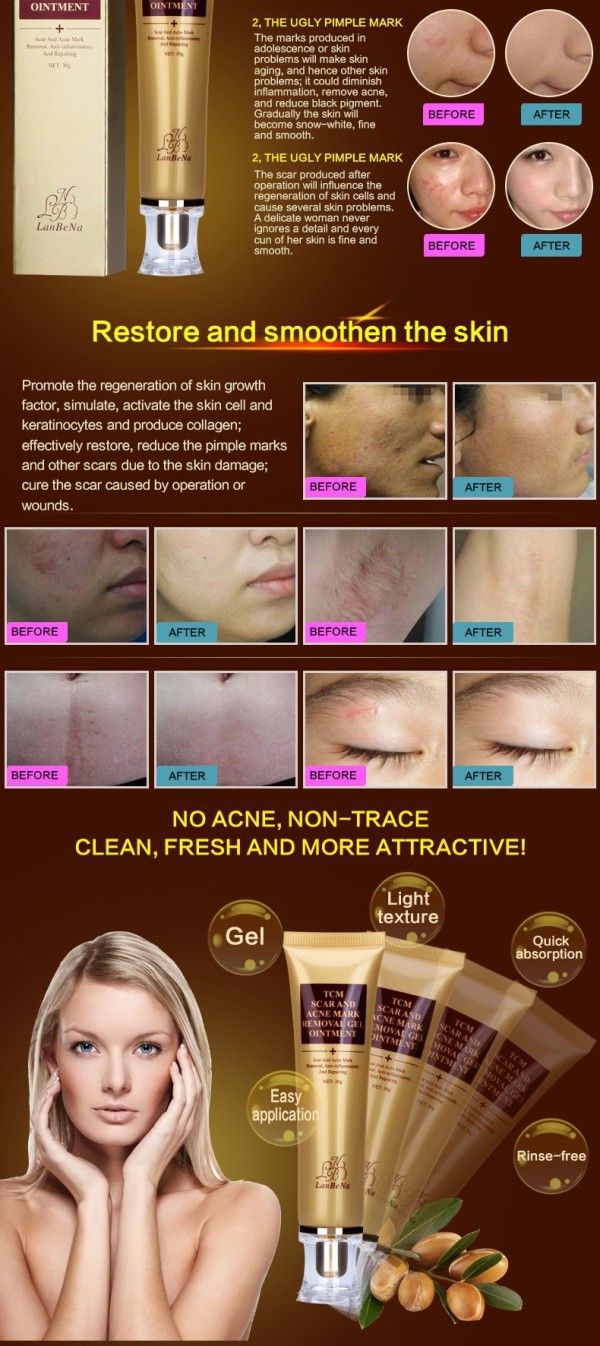 LANBENA Acne Scar Removal Cream Skin Repair Face Cream Acne Spots Acne Treatment Blackhead Whitening Cream Stretch Marks 30ml