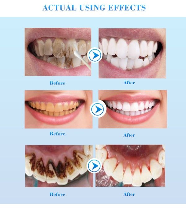 Clean Tooth Beauty Bai Cleaning Liquid White Tooth Powder To Black Teeth Yellow Teeth Teeth Tea Stains 10g