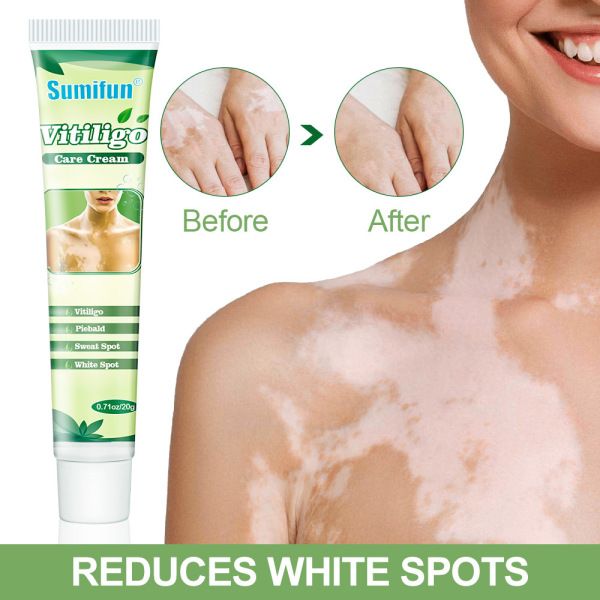 20g Vitiligo Treatment Cream White Spot Antibacterial Ointment Localized Leukoplakia Repair Medical Herbs Beauty Health