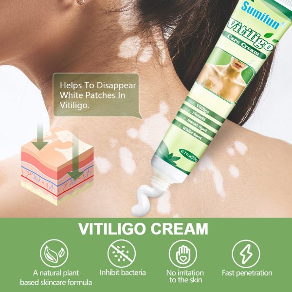 20g Vitiligo Treatment Cream White Spot Antibacterial Ointment Localized Leukoplakia Repair Medical Herbs Beauty Health