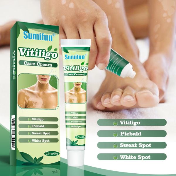 20g Vitiligo Treatment Cream White Spot Antibacterial Ointment Localized Leukoplakia Repair Medical Herbs Beauty Health