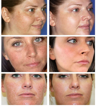 Effective Whitening Cream To Remove Melasma Acne Spot Pigment Melanin Black Spot Pigmentation Moisturizing Cream B2-624