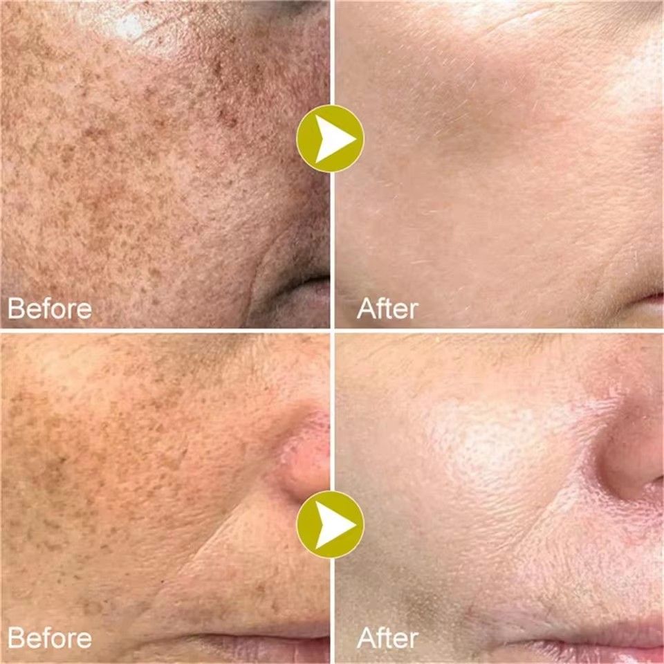 BARUBT Powerful bleaching cream removing stains, lightens the skin, quickly removes melanin pigmentation, melasma, dark spots B2-1028