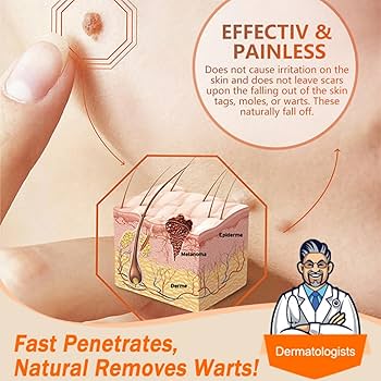 Aichun Beauty Anti-Wart Cream Warts Remover Cream Wart Treatment, Skin Tags & Light Moles Removal -20g