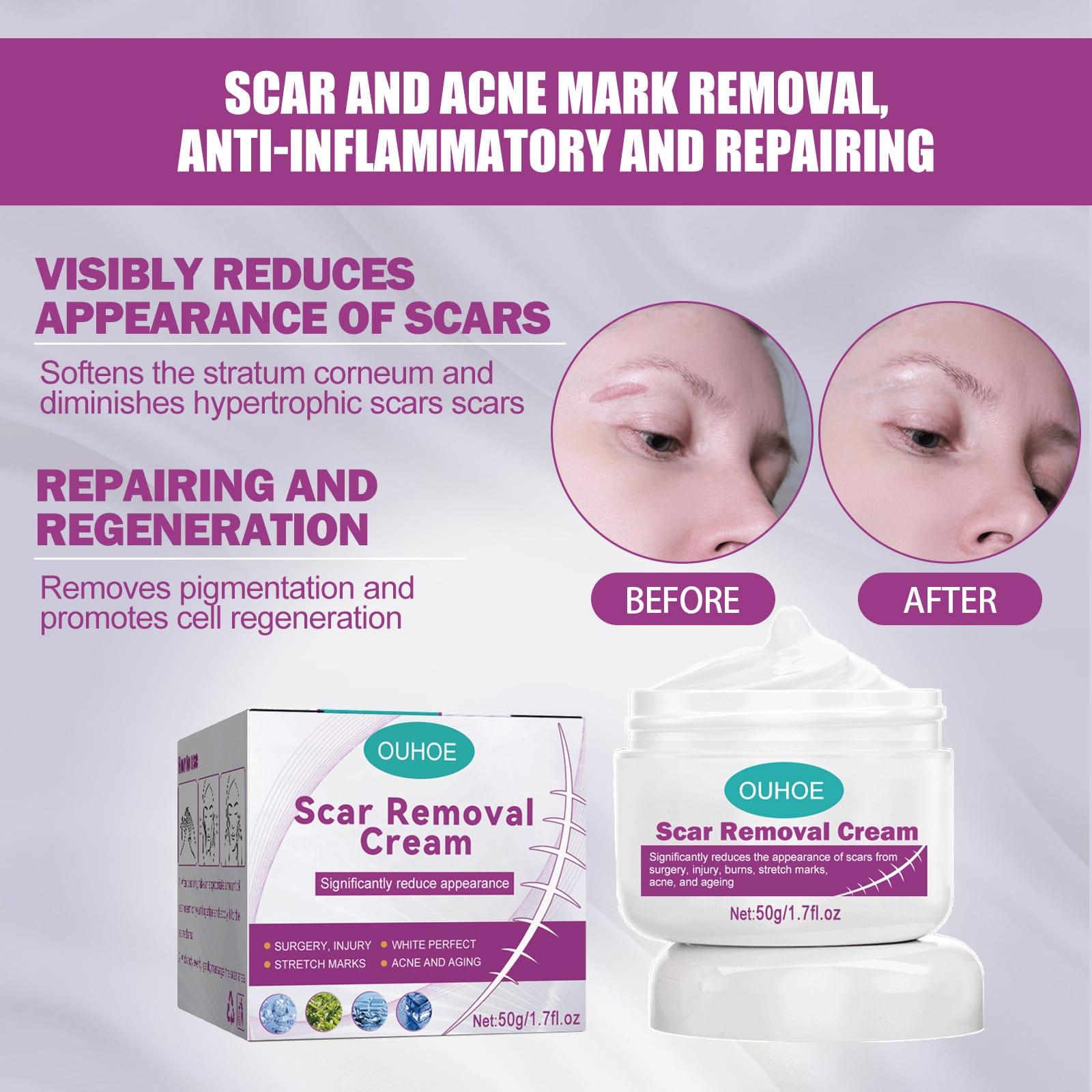 100% effective scar removal cream 50g
