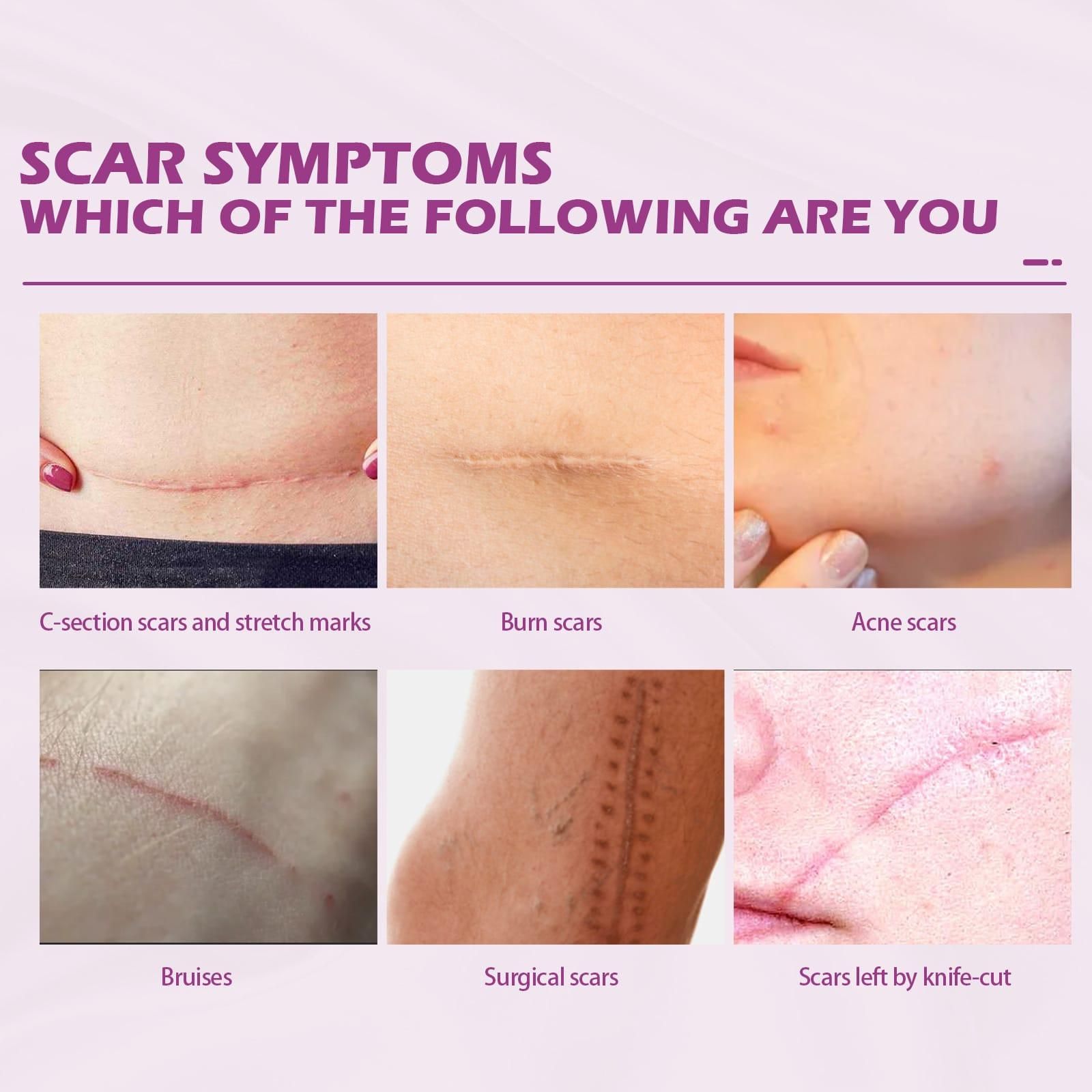 100% effective scar removal cream 50g
