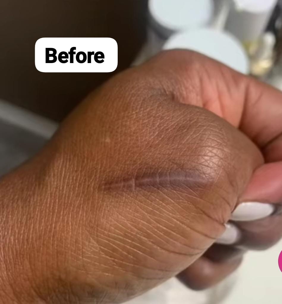 INSTANT SCAR FADE GEL – ERASE ACNE MARKS & DARK SPOTS FAST