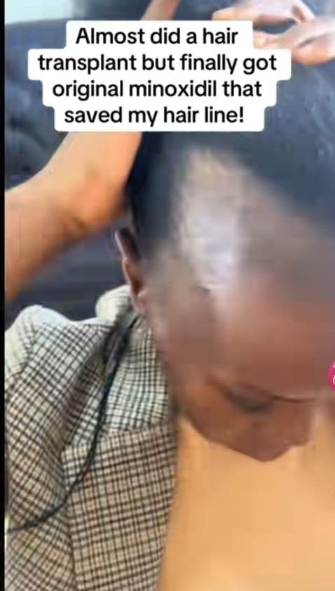 KIRKLAND MINOXIDIL 5% EXTRA STRENGTH HAIR REGROWTH SOLUTION – 1 MONTH SUPPLY + FREE DROPPER