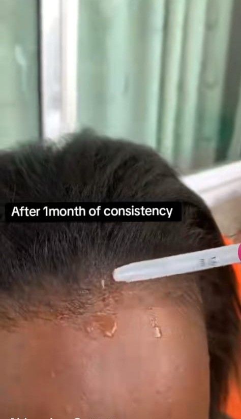 KIRKLAND MINOXIDIL 5% EXTRA STRENGTH HAIR REGROWTH SOLUTION – 1 MONTH SUPPLY + FREE DROPPER