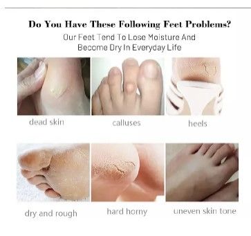 GuanJing Foot Skin Care Foot Mask Socks Peeling Remove Dead Skin Cells Moisturizing Exfoliating Foot Mask Exfoliating Gel Moisturizing For Women and Men 1 Pair Foot patch Footpatch