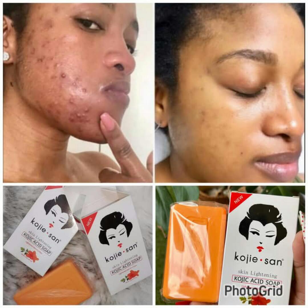 Kojie San Whitening Soap – Kojic Acid Brightening Bar for Dark Spots, Acne & Even Skin Tone – 135g