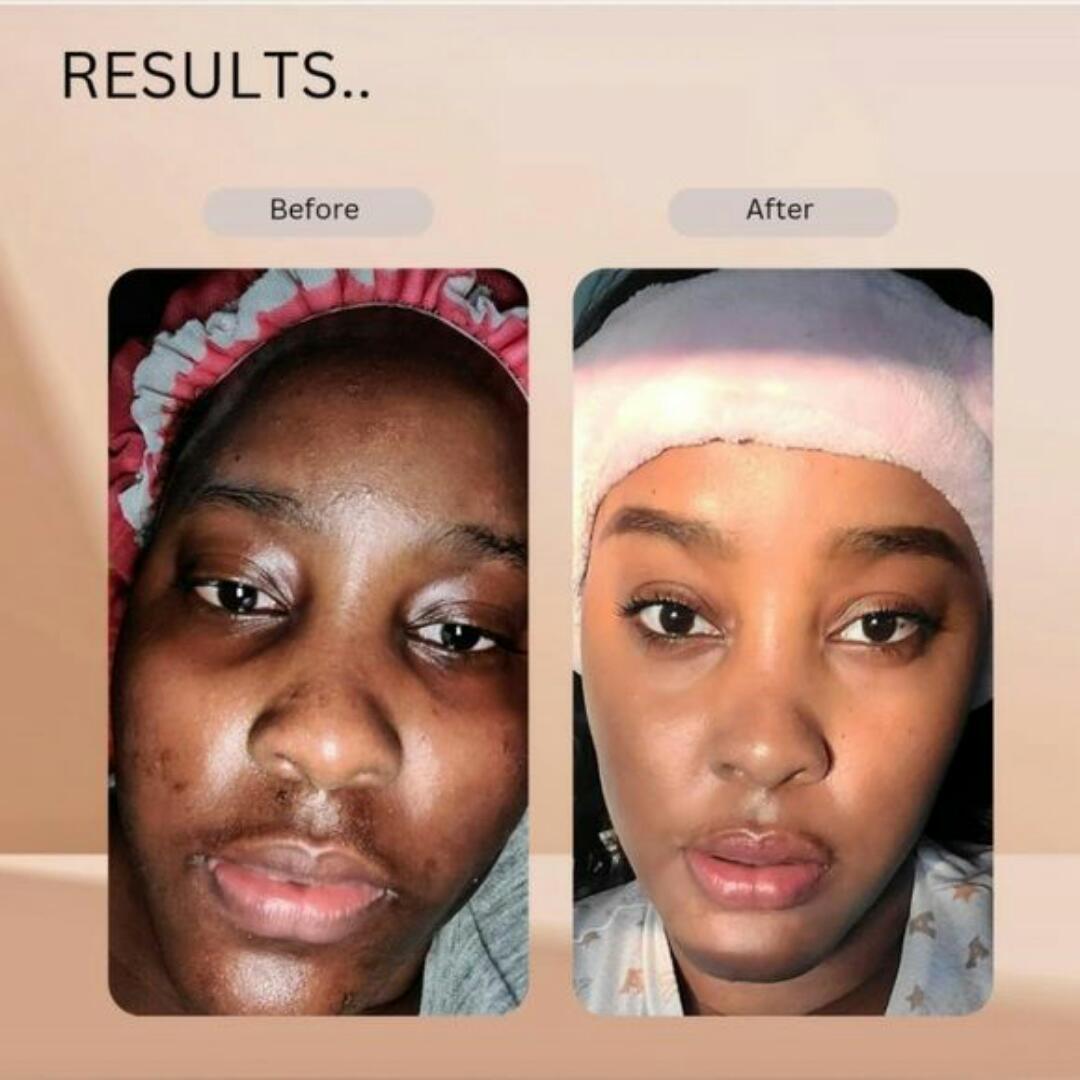 Kojie San Whitening Soap – Kojic Acid Brightening Bar for Dark Spots, Acne & Even Skin Tone – 135g