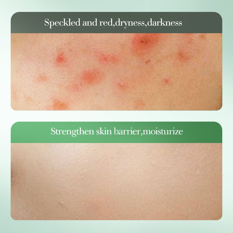 Sadoer 4 in 1 Set, Salicylic Acid 3% Dispel Acne, Acne Repair Toner + Serum + Cream + Cleanser, Gentle Amino Acid Cleanser, (Can use Together with Vitamin C), Removes Acne, Moisturize, Rejuvenate, Rep