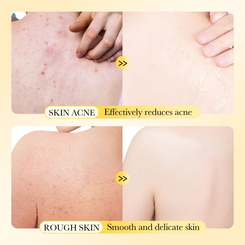 Sadoer 3 Pieces Sulfur Soap Mite Removal Soap, for Gentle Cleaning, Remove Acne and Smooth Skin