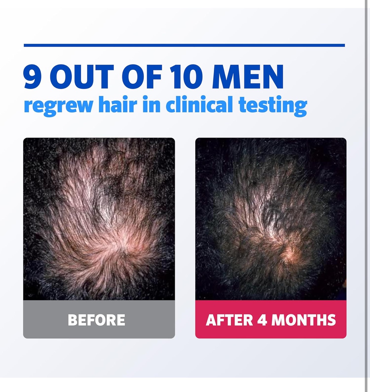 Men's Rogaine 5% Minoxidil Foam for Hair Regrowth, Topical Hair Loss Treatment to Regrow Fuller, Thicker Hair, Unscented