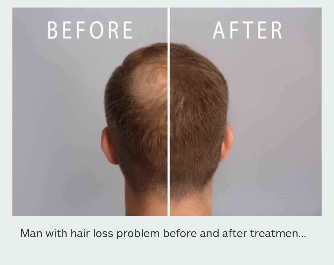 MINOXY F Minoxidil and Finasteride Topical Solution Hair Loss Treatment to Regrow Fuller, Thicker Hair, Unscented 60ml