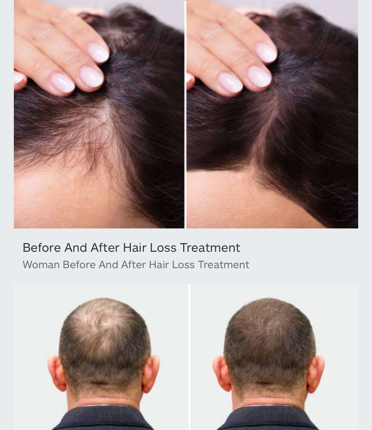 MINOXY F Minoxidil and Finasteride Topical Solution Hair Loss Treatment to Regrow Fuller, Thicker Hair, Unscented 60ml