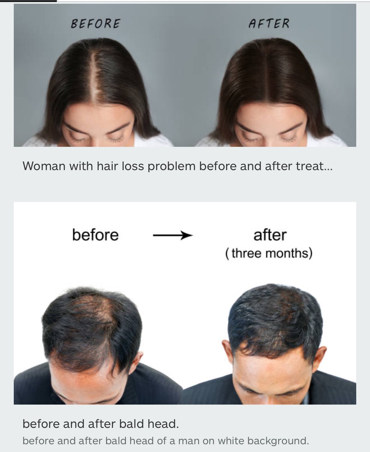 MINOXY F Minoxidil and Finasteride Topical Solution Hair Loss Treatment to Regrow Fuller, Thicker Hair, Unscented 60ml