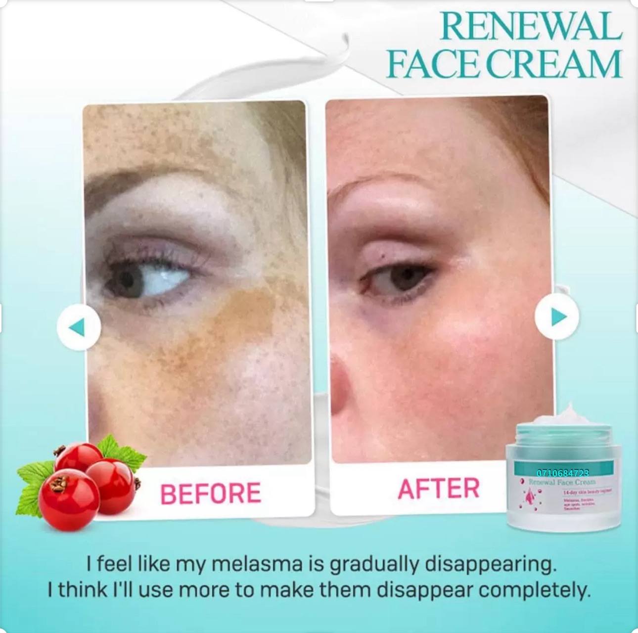 Renewal Face Cream, 14-day beauty regimen for Melasma, freckles, acne and eczema