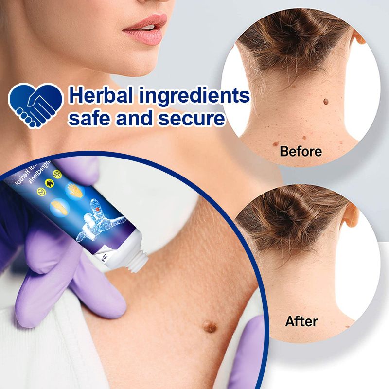 Sumifun Skin Tag Remover, 20g Wart Removal Cream for Effective and Safe Results. Gently Removes Corns on Feet and Hands, Keeps Skin Smooth and Healthy