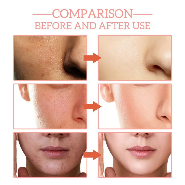 1pc, 5 In 1 Facial Serum, Moisturizing Smoothing Wrinkle Vitamin C Hyaluronic Acid Face Serum, Shrink Pores Serum, Skin Care