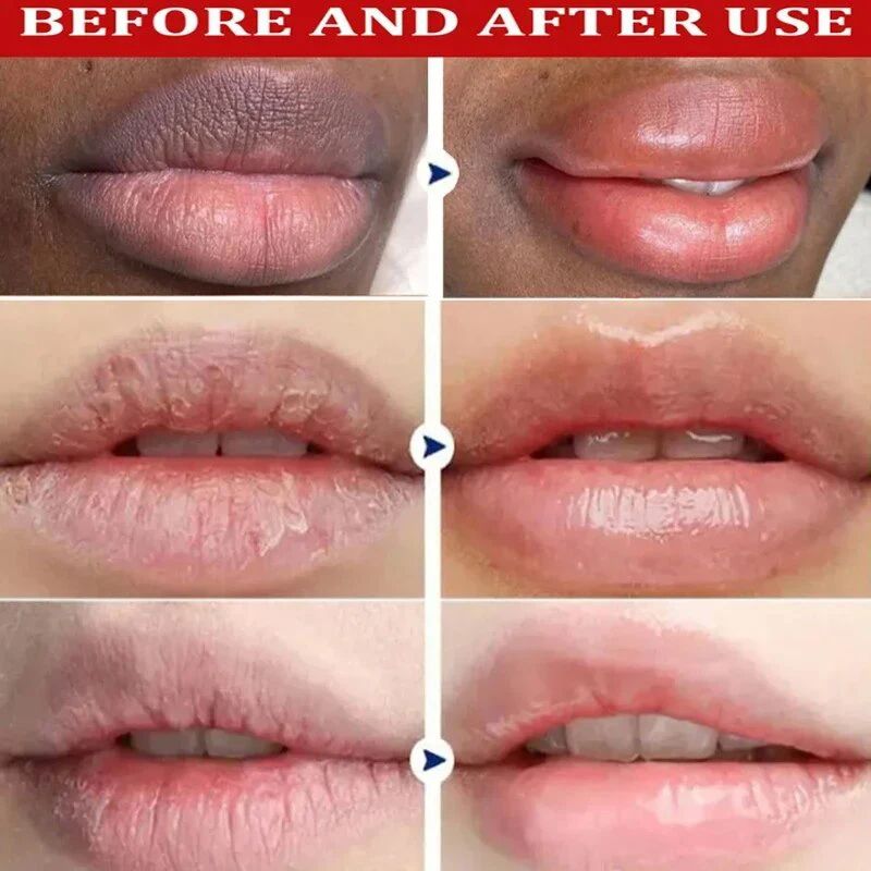 Whitening Remove Dark Lip Balm Moisturizing Cream Hyaluronic Acid Exfoliating Dead Skin Lightening Pigment Care Beauty Health