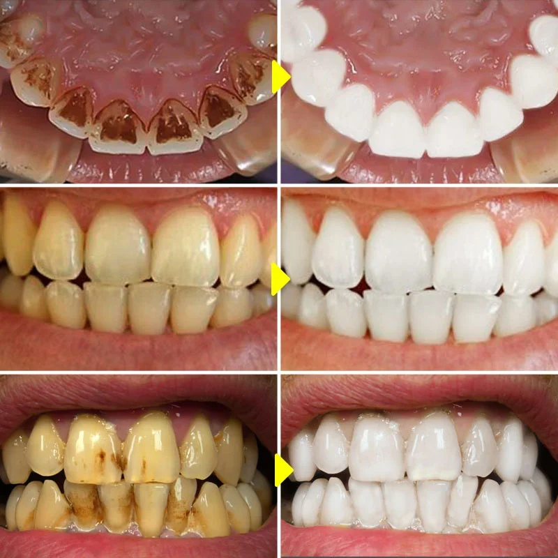 Probiotic Caries Toothpaste SP4 Whitening Repair Tooth Decay Paste Cleaner Teeth Remover Plaque Fresh Breath Oral Care