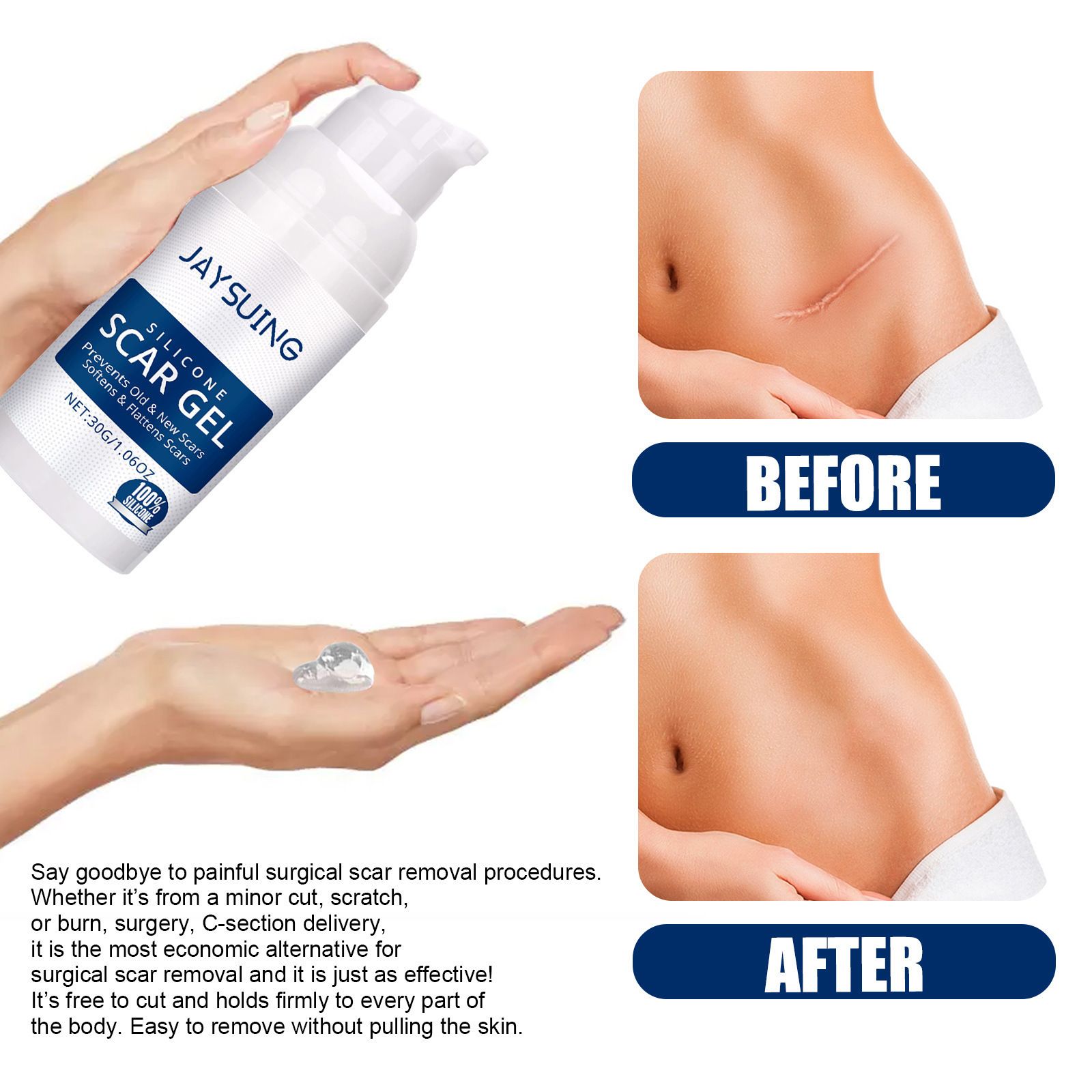 Advanced Scar Gel Medical-Grade Silicone for Face, Body, Stretch Marks, C-Sections, Surgical, Burn, Acne, Old & New Scars
