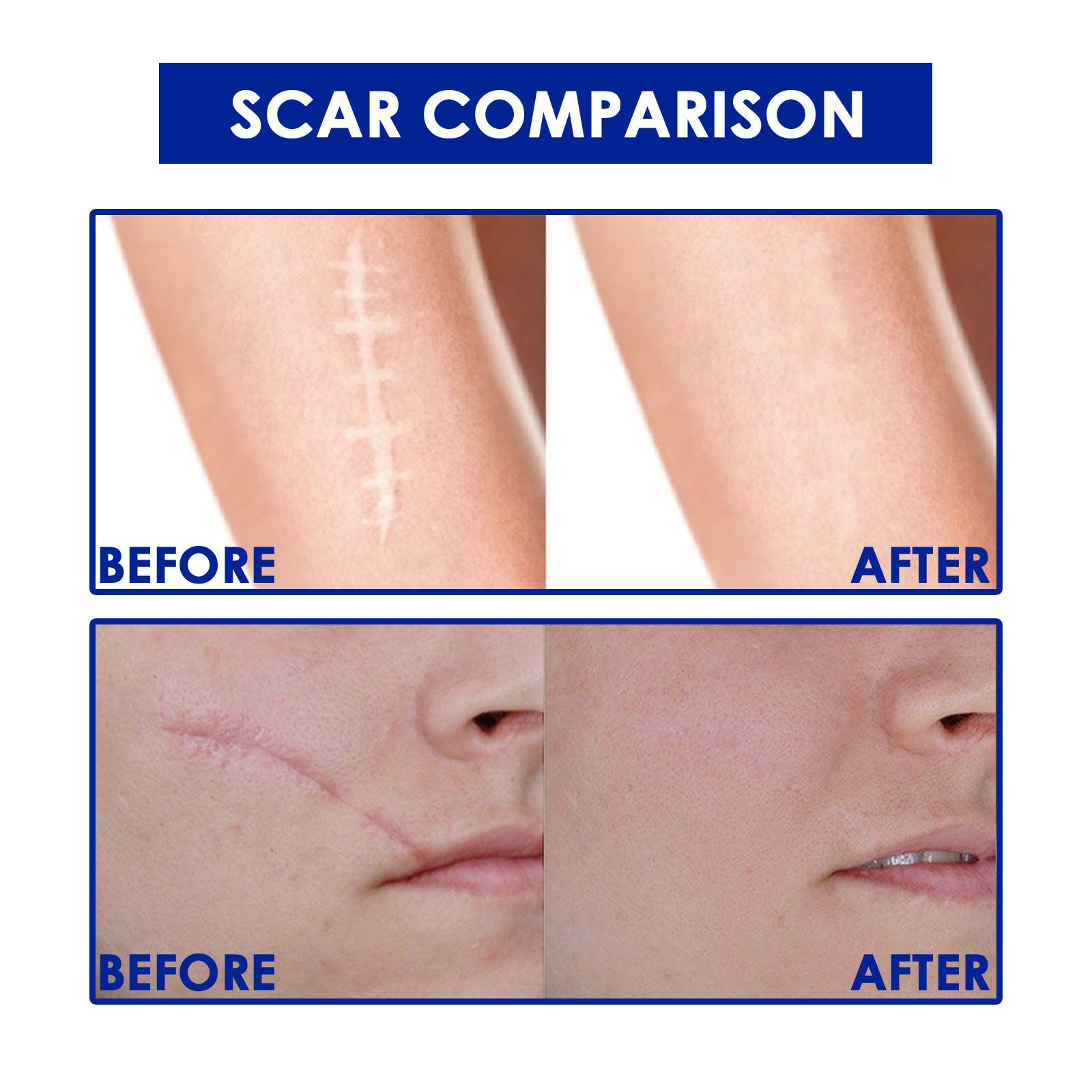 Scar removal  Gel，Advance Scar Gel，Advanced Formula Scar Gel for Old & New Scars, Acene, C-Section, Stretch Marks, Old and New Scars ,Keloids Scar Removal Cream (2PCS)