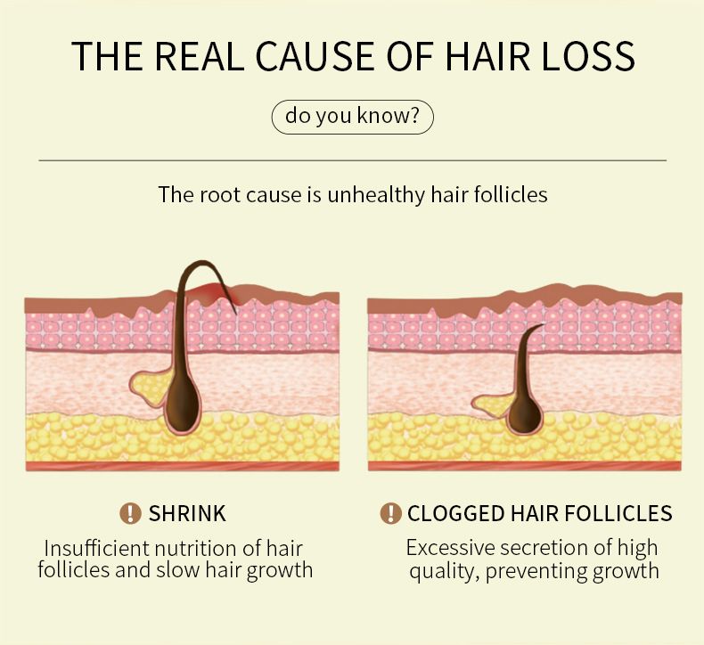 Natural Hair Growth Oil, Zingiber Officinale,Rosemary Oil for Hair Growth Organic, Veganic Natural Hair Growth Oil for Thin Hair, Hair Oil for Dry Damaged Hair and Growth，60ml