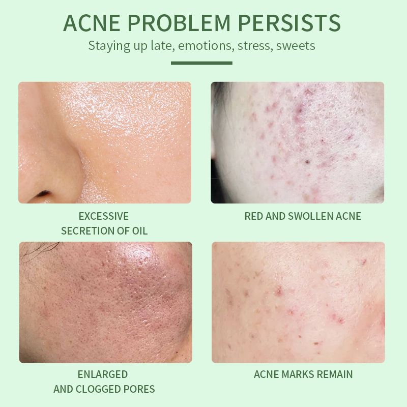 Acne Treatment Serum with 2% Salicylic Acid & Niacinamide-Precision Acne Spot Serum, Acne Drying Lotion, Overnight Acne Treatment For Face, Dry Out Pimples, Blemishes, Zits And Clean Pores, 0.42 Fl O