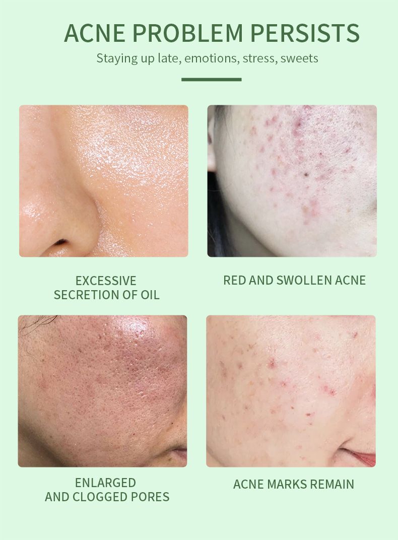 Acne Treatment Serum with 2% Salicylic Acid & Niacinamide-Precision Acne Spot Serum, Acne Drying Lotion, Overnight Acne Treatment For Face, Dry Out Pimples, Blemishes, Zits And Clean Pores, 0.42 Fl O