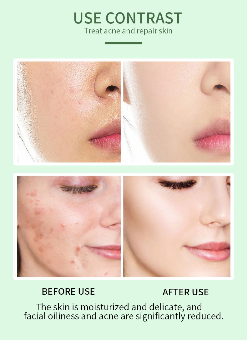 Acne Treatment Serum with 2% Salicylic Acid & Niacinamide-Precision Acne Spot Serum, Acne Drying Lotion, Overnight Acne Treatment For Face, Dry Out Pimples, Blemishes, Zits And Clean Pores, 0.42 Fl O