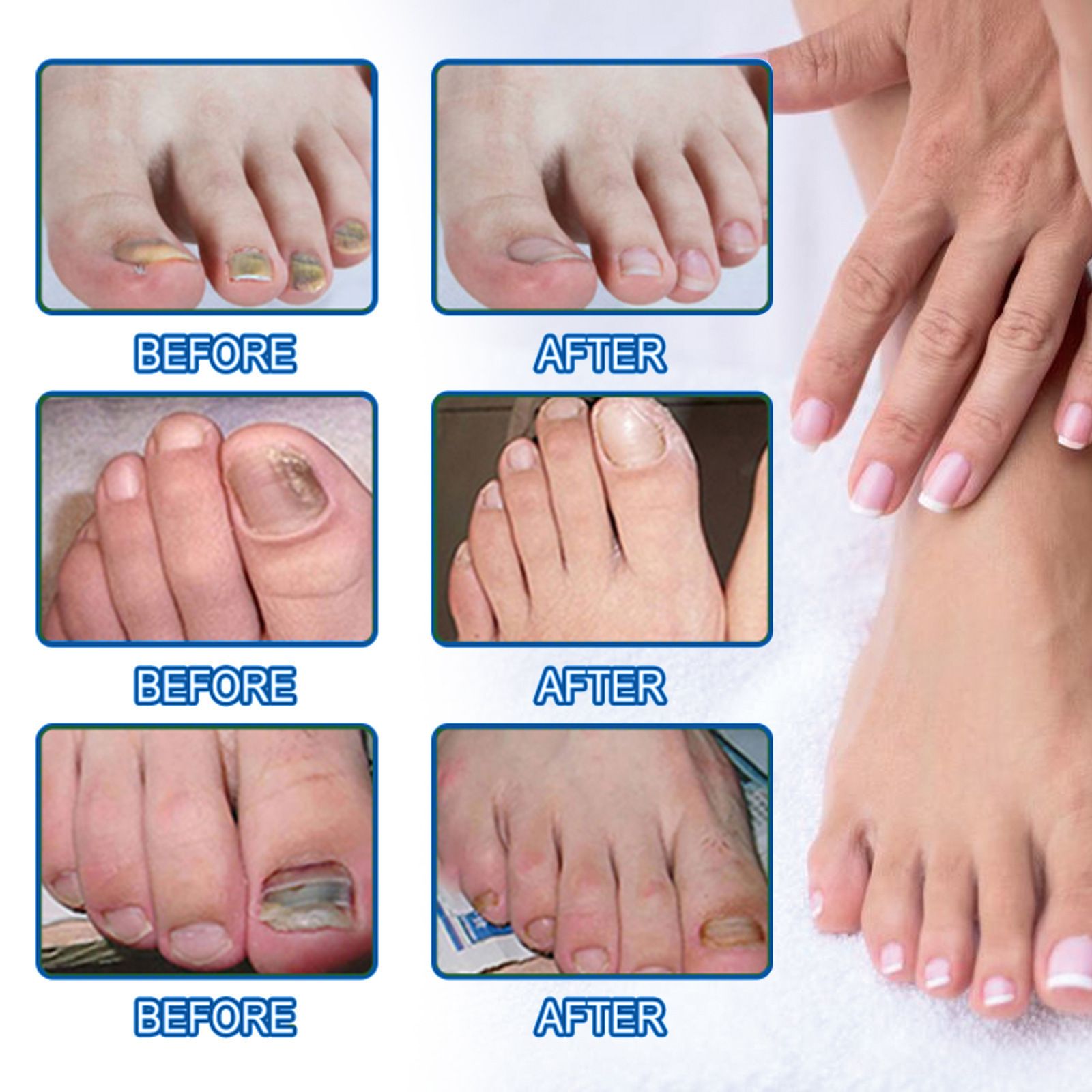 Toenail Fungus Cleansing Extra Strength,60pcs Fungal Nail Patches 8-Hour Overnight Nail Repair Effortless Restore Healthy Nail Appearance