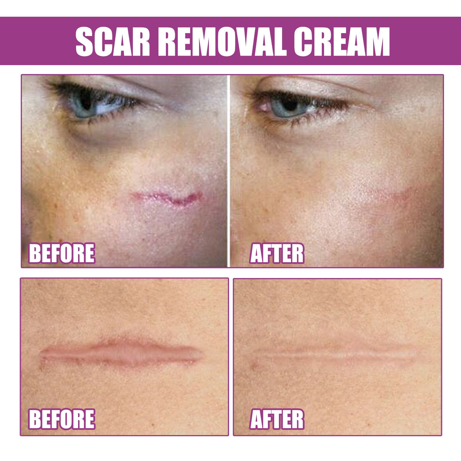 Scar Removal Cream for Men and Women, Ouhoe Scar Cream Smoothing Firming and Fading, Advanced Scar Gel for Face Body Leg, Fast Results, Gentle for All Skin Types