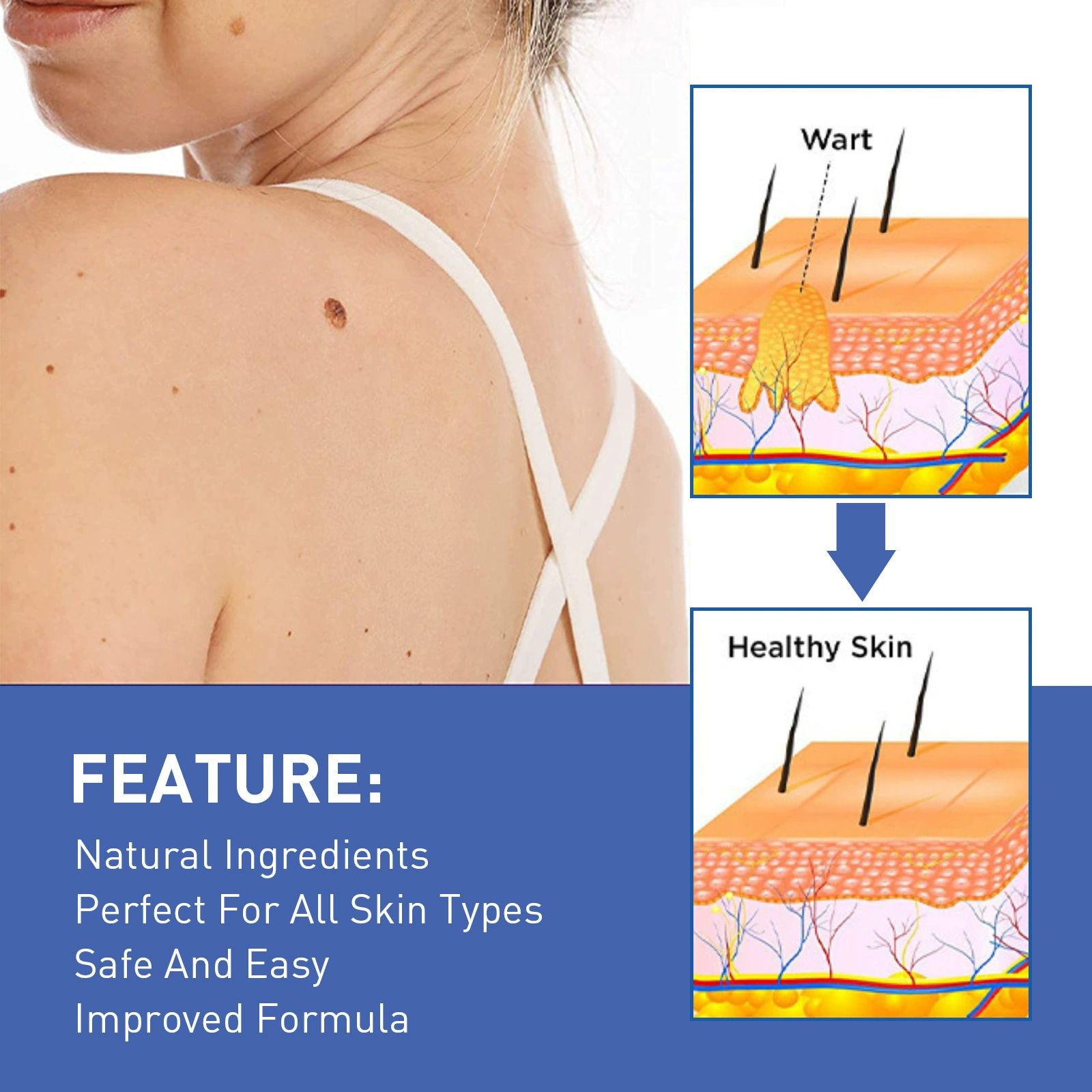 Warts Remover Antibacterial Ointment Wart Treatment Cream Skin Tag Remover Herbal Extract Corn Plaster Warts Ointment