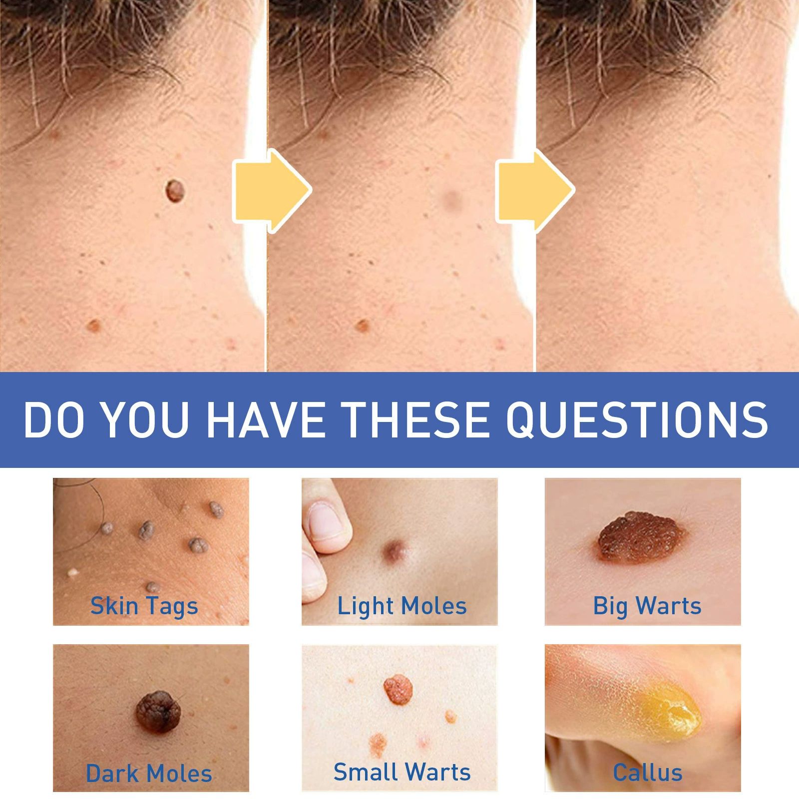 Warts Remover Antibacterial Ointment Wart Treatment Cream Skin Tag Remover Herbal Extract Corn Plaster Warts Ointment