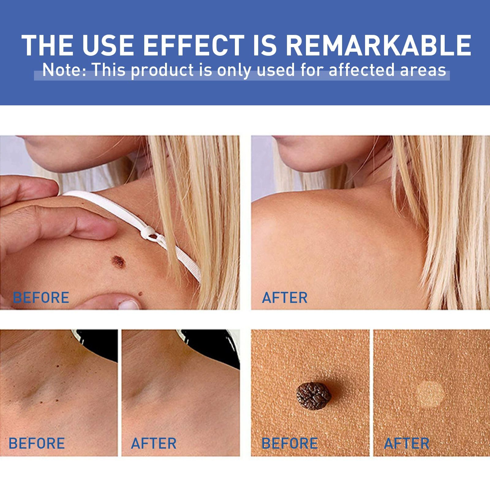 Warts Remover Antibacterial Ointment Wart Treatment Cream Skin Tag Remover Herbal Extract Corn Plaster Warts Ointment