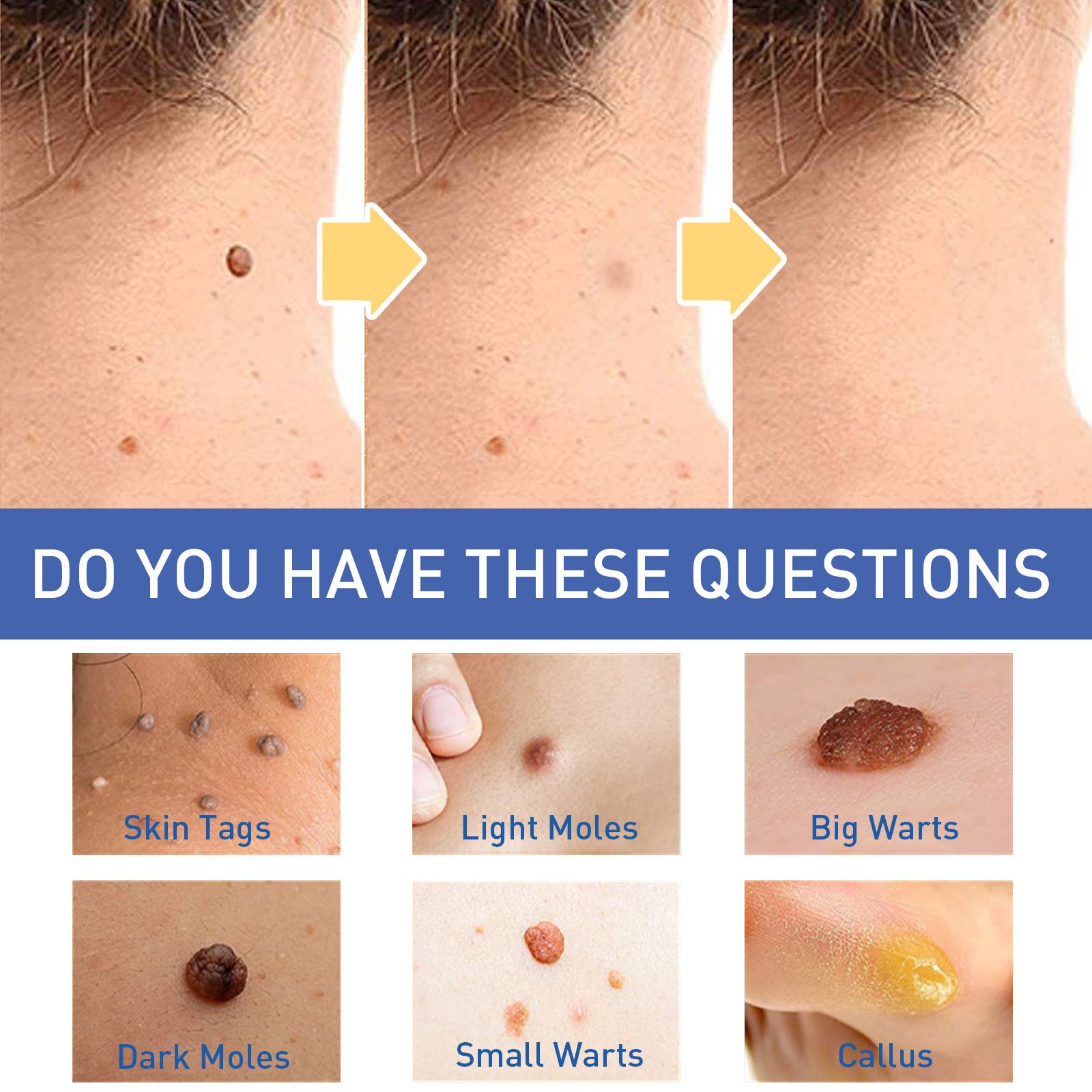 Warts Remover Antibacterial Ointment Wart Treatment Cream Skin Tag Remover Herbal Extract Corn Plaster Warts Ointment