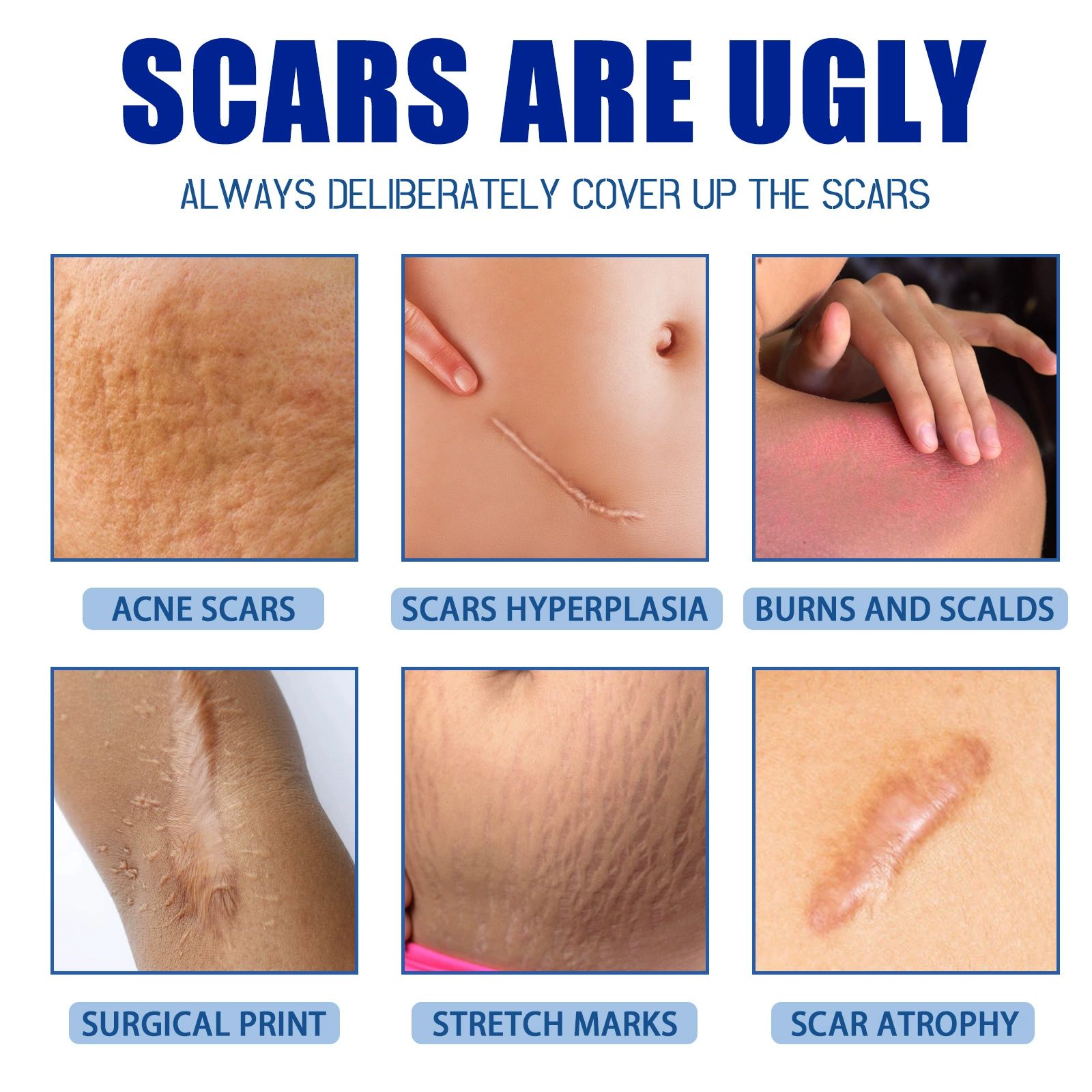 Scar Cream,Silicone Scar Gel,Scar Removal Cream,Scar Silicone Gel,Scar Gel,Scar Cream for Surgical Scars and Keloid Bump (1pcs)