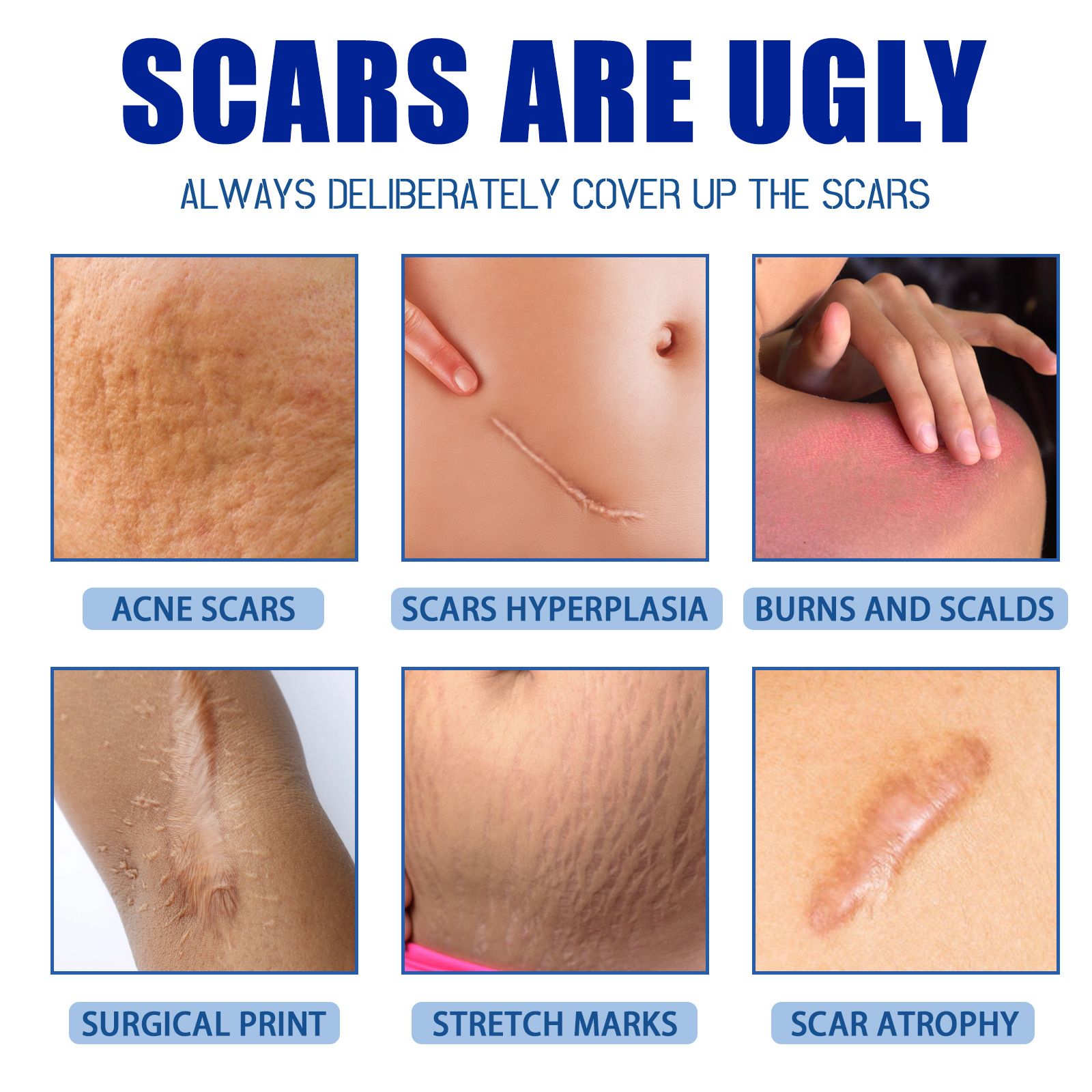 Scar Cream,Silicone Scar Gel,Scar Removal Cream,Scar Silicone Gel,Scar Gel,Scar Cream for Surgical Scars and Keloid Bump (1pcs)
