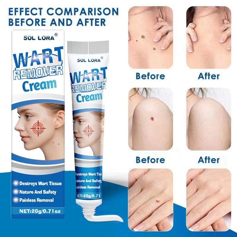 Warts Remover Cream, Fast-Acting Wart Ointment with Maximum Strength for Home Use, Safe and Effective
