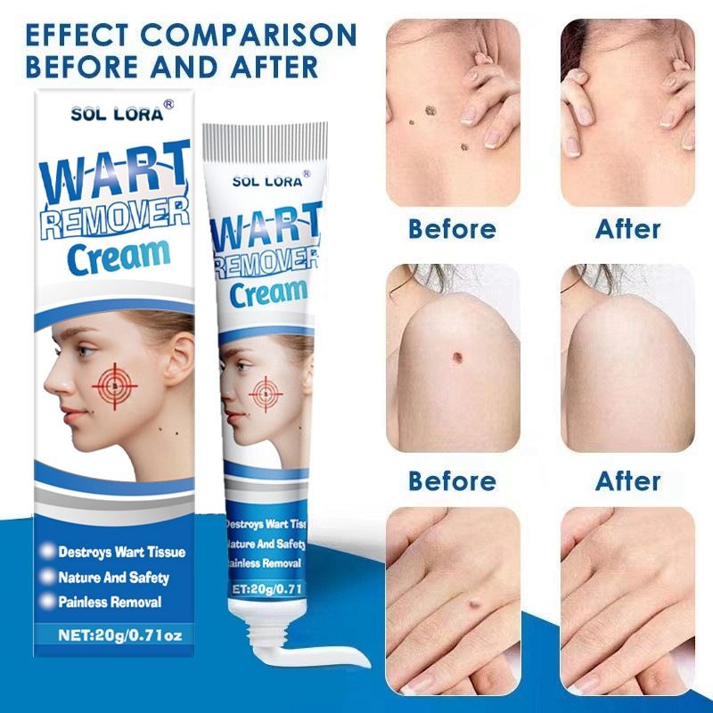 Warts Remover Cream, Fast-Acting Wart Ointment with Maximum Strength for Home Use, Safe and Effective