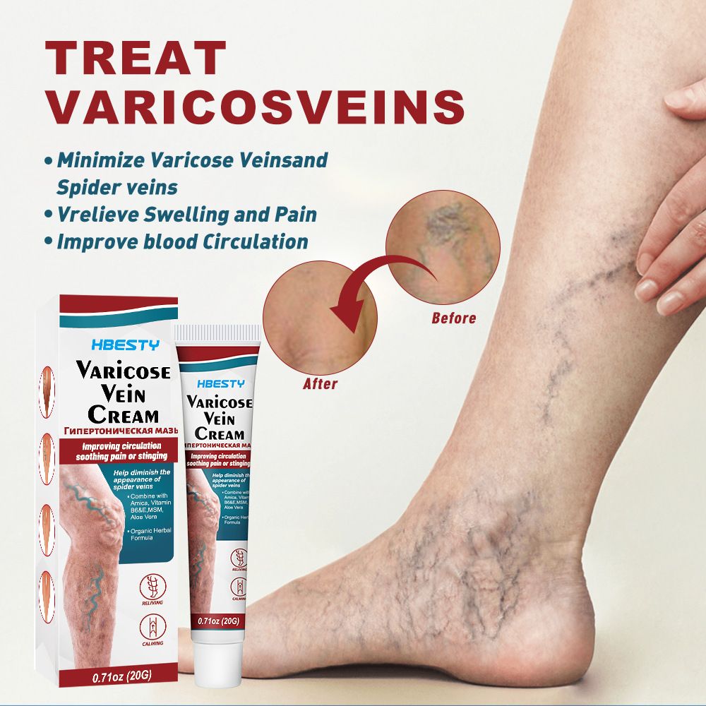 2PCS Varicose Veins treatment for legs,Anti Varicose Vein Soothing Leg Cream,Improves Blood Circulation, Reduces Varicose Veins and Heaviness Lymphatic Massage Cream 20G/0.70OZ